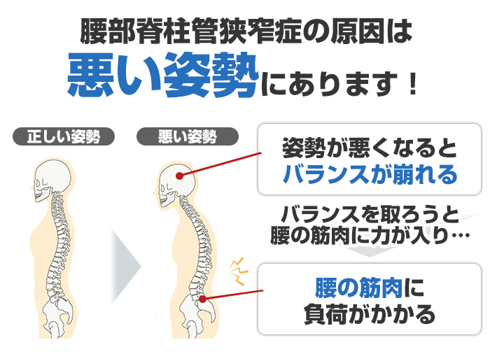 脊柱管狭窄症の原因